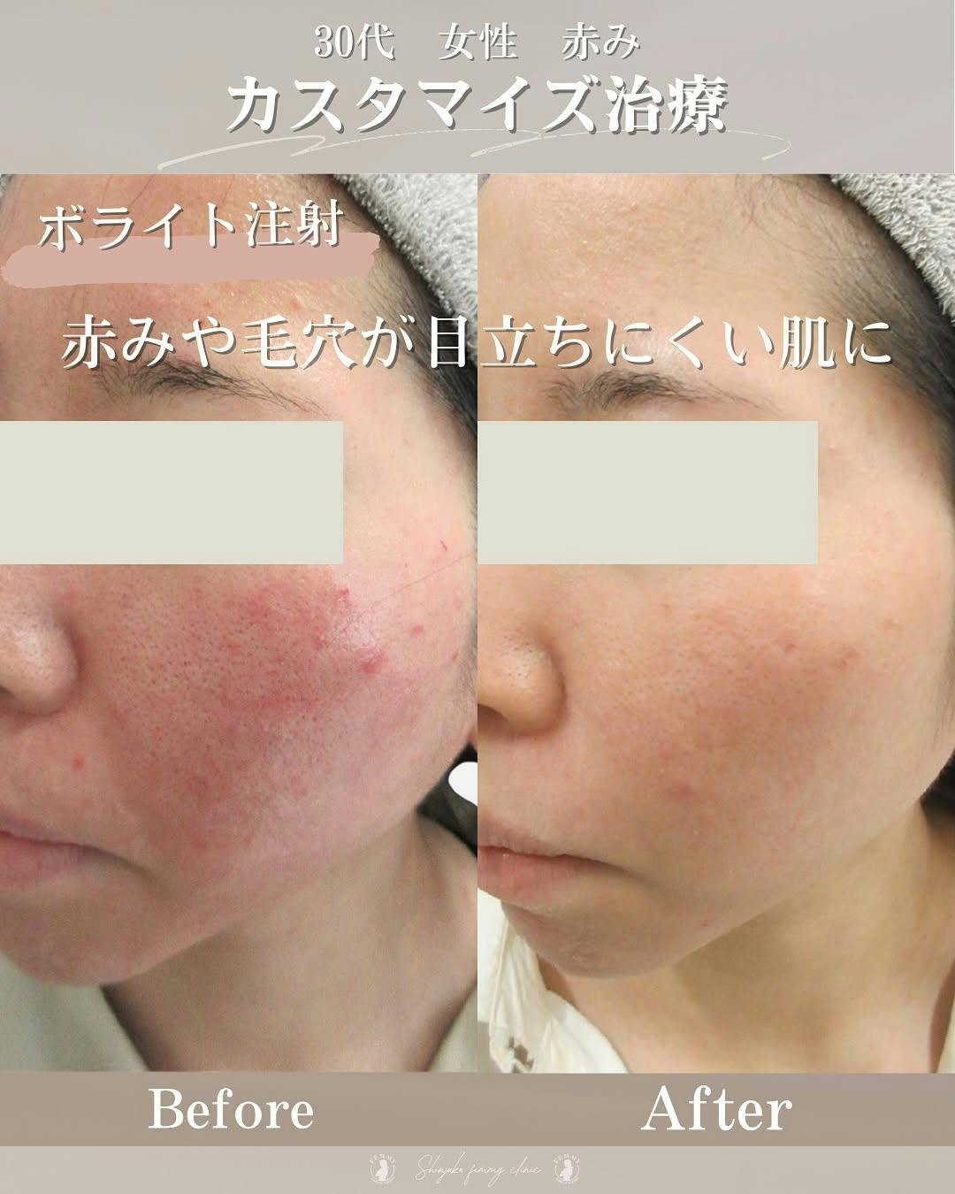 【30代女性・赤み】ボライト・イソトロイン_before_aftar