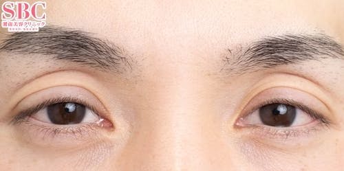 【40代男性・目元】眼瞼下垂＋二重_before