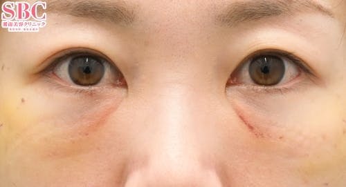 【30代女性・目元】目の下の切らないクマ・たるみ（ふくらみ）取り、ナチュラル脂肪注射コンデンスリッチ、ナチュラル脂肪注射ナノリッチ_1week