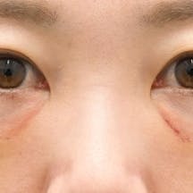 【30代女性・目元】目の下の切らないクマ・たるみ(ふくらみ)取り、ナチュラル脂肪注射コンデンスリッチ、ナチュラル脂肪注射ナノリッチ_1week