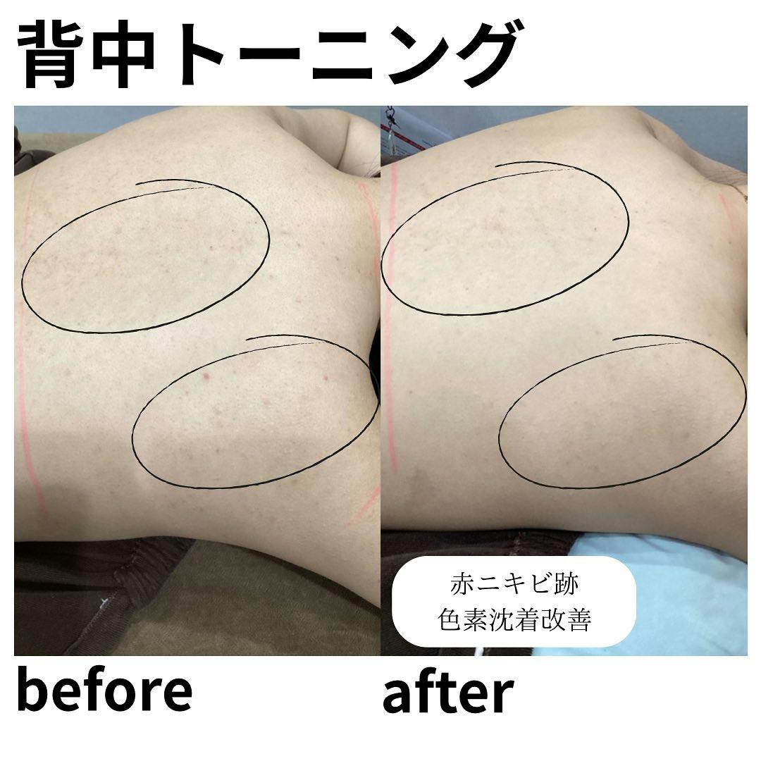 【女性・背中】トーニング_before_aftar