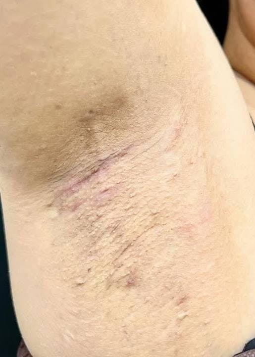 湘南美容クリニック 渋谷院でワキガ・多汗症治療：完全摘出法を受けたB-子さんの写真