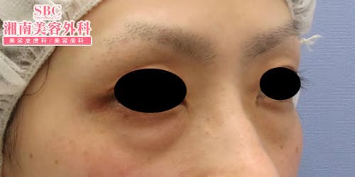 【女性・目元】目の下の切らないクマ・たるみ（ふくらみ）取り・ナチュラル脂肪注射コンデンスリッチ・ナチュラル脂肪注射_before