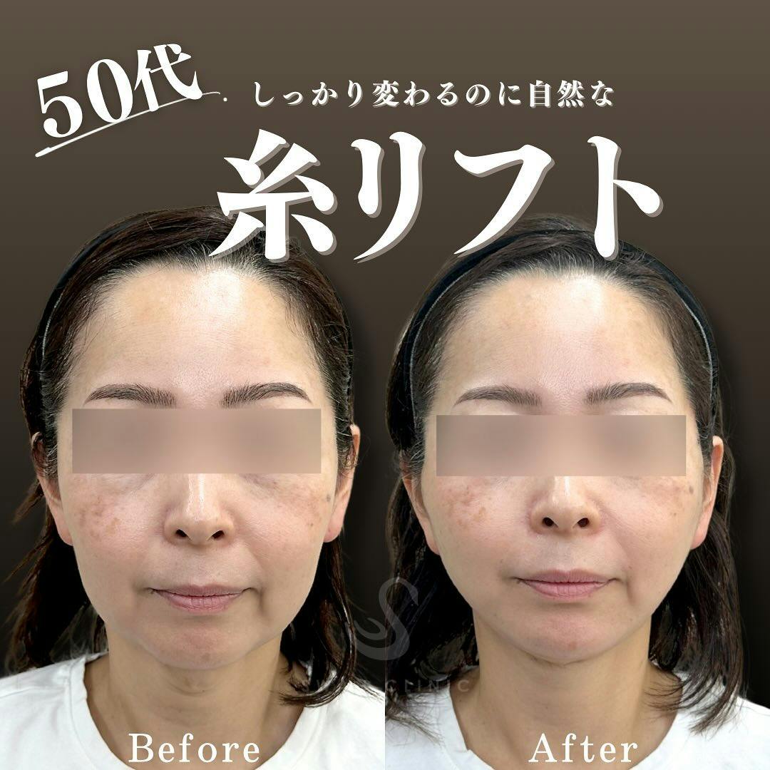 【50代女性・輪郭】糸リフト(培養上清注入) 口横サーマジェン ヒアルロン酸 ボトックス(額·目尻·鼻根·顎)_before_aftar