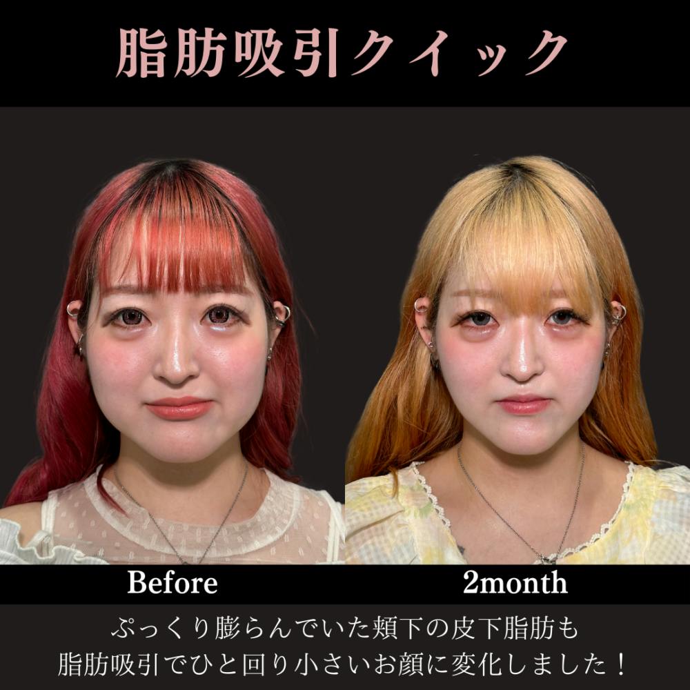 【20代女性・頬】脂肪吸引クイック（頬）_before_aftar