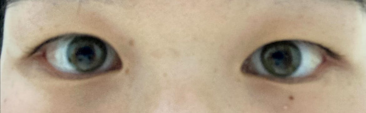 湘南美容クリニック Regno銀座院で二重整形・二重埋没・奥二重整形・末広二重整形・平行二重整形・ミックス型二重整形・目元整形を受けたるんさんの写真