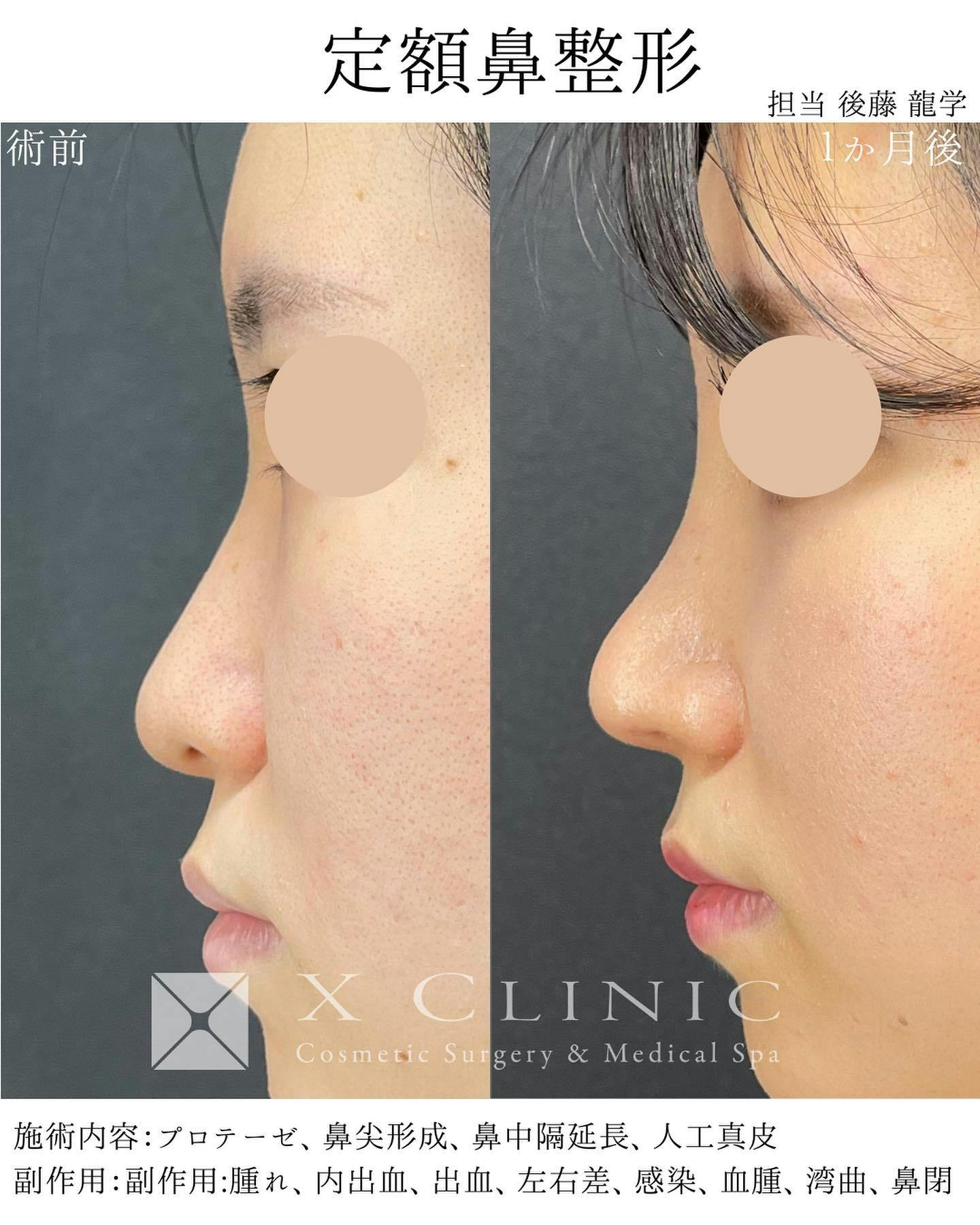 【女性・鼻】定額鼻整形（プロテーゼ、鼻尖形成、鼻中隔延長、人工真皮）_before_aftar