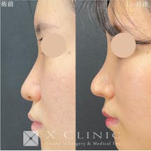 【女性・鼻】定額鼻整形(プロテーゼ、鼻尖形成、鼻中隔延長、人工真皮)_before_aftar