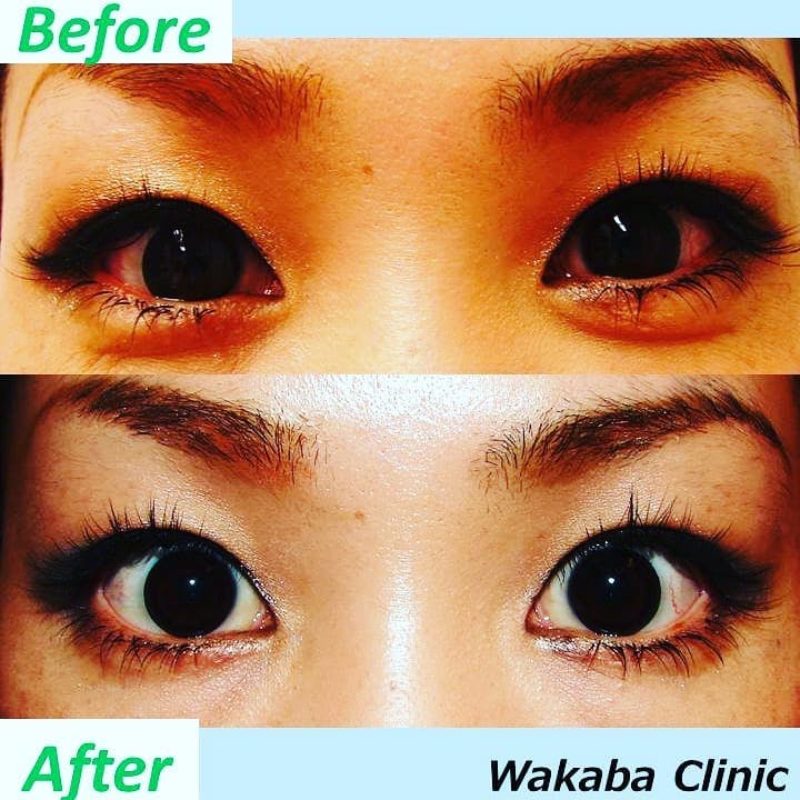 【女性・目元】ボトックス_before_aftar