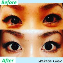 【女性・目元】ボトックス_before_aftar