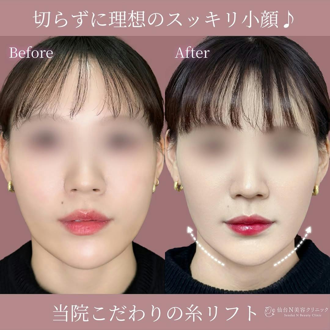 【女性・輪郭】糸リフト_before_aftar