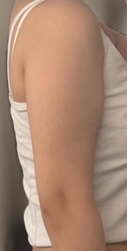 ガーデンクリニック 新宿院で脂肪吸引：二の腕の脂肪吸引を受けたheathさんの写真