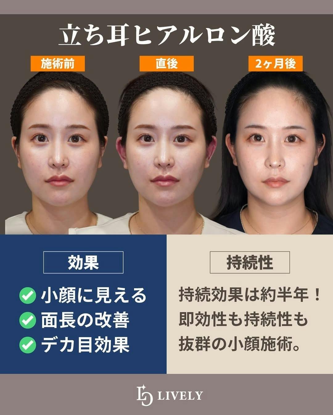 【女性・耳】立ち耳ヒアルロン酸_before_aftar