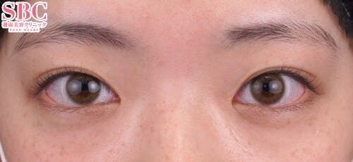 【10代女性・目元】クイックコスメティーク・トリプルNeo_before