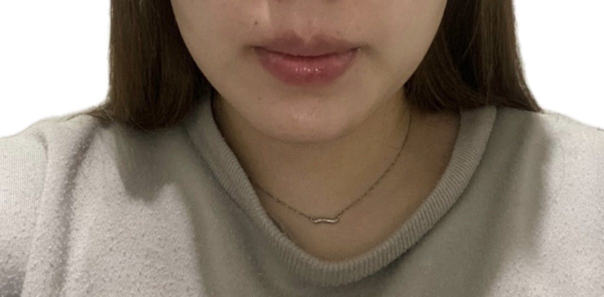 湘南美容クリニック 横浜院でボトックスを受けためめさんの写真