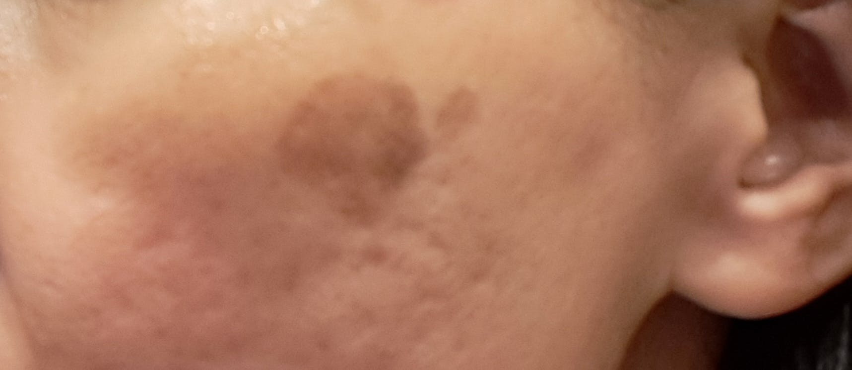 SNOW CLINICでスノーピコトーニングを受けたジャスミンさんの写真