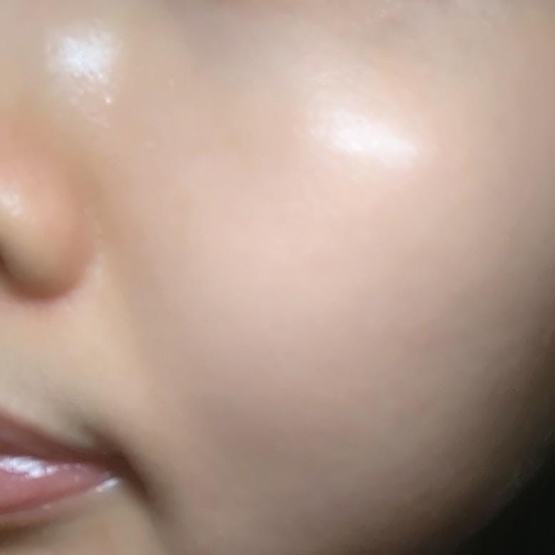 松田知子皮膚科医院でホクロ切除を受けたみるみさんの写真