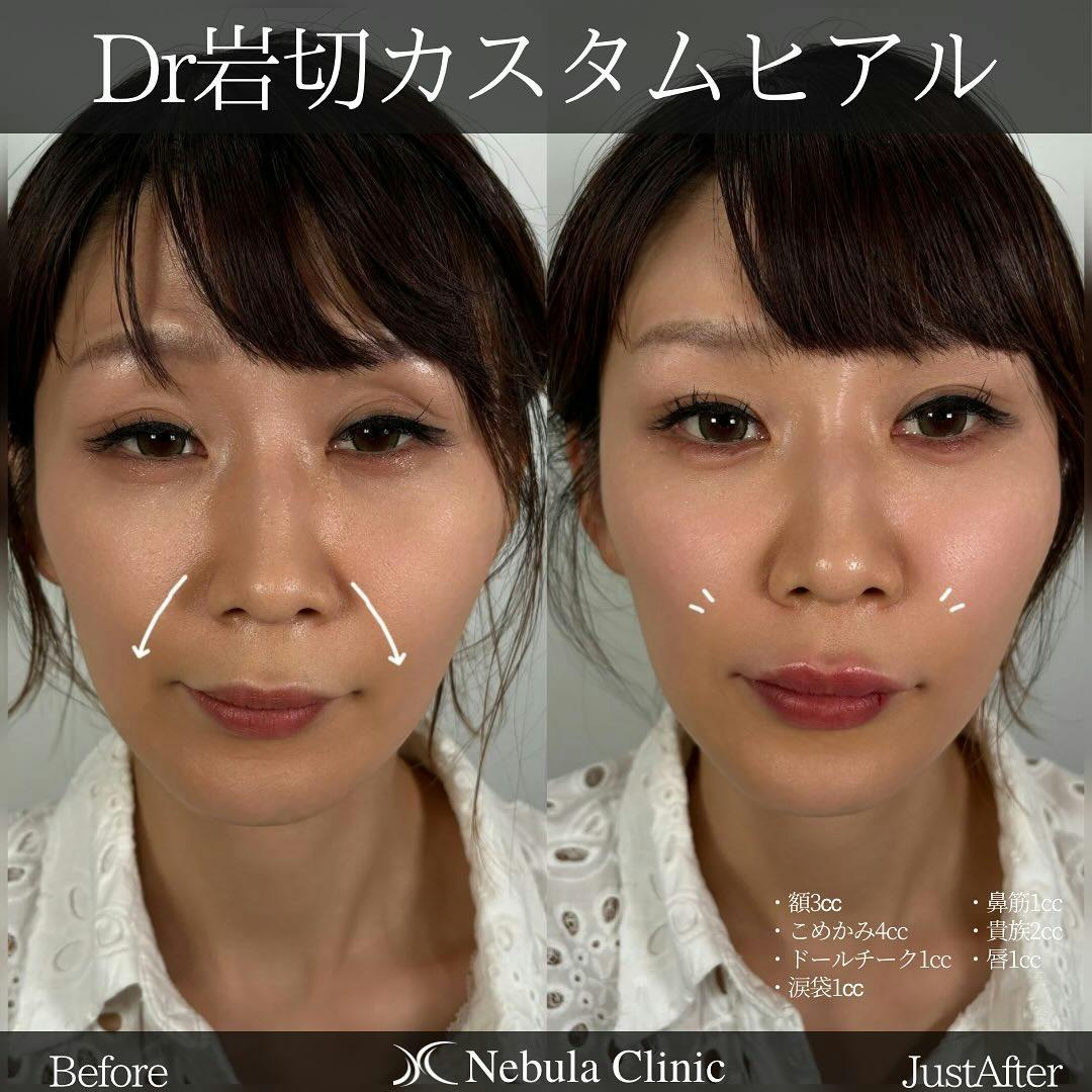 【女性・額・こめかみ・頬・涙袋・鼻筋・小鼻・唇】ヒアルロン酸注入(額・こめかみ・ドールチーク・涙袋・鼻筋・貴族・唇)_before_aftar