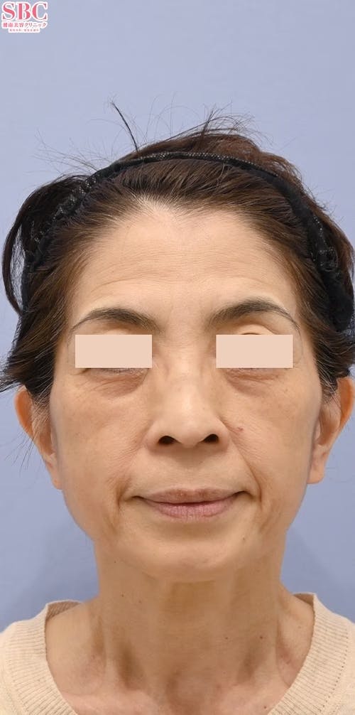 【女性・たるみ】VOV（ボブ）リフト、ヒアルロン酸ジュビダームビスタ ウルトラプラスXC_before