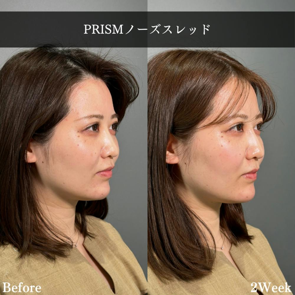 【20代女性・鼻】PRISMノーズスレッド_before_aftar
