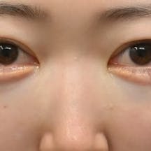 【20代女性・目元】目の下の切らないクマ・たるみ(ふくらみ)取り ナチュラル脂肪注射コンデンスリッチ ナチュラル脂肪注射ナノリッチ_after