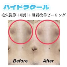 【女性・毛穴】ハイドラクール_before_aftar