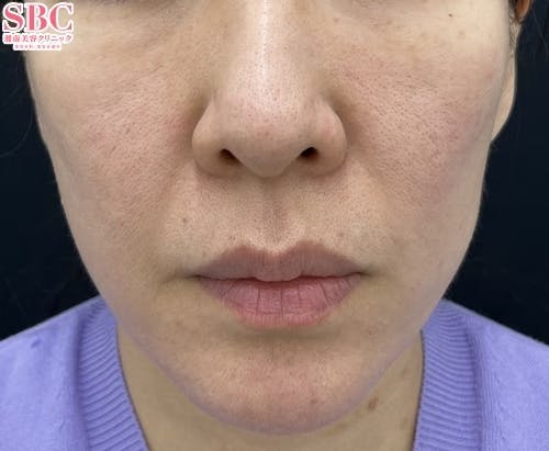 【女性・顔】シルファームX・プロファイロ_before