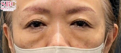 【50代女性・目元】目の下の切らないクマ・たるみ（ふくらみ）取り_before