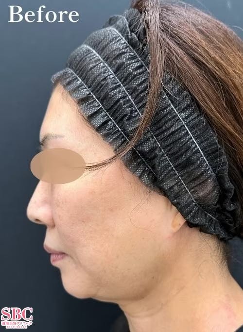 【50代女性・輪郭】美ボディ脂肪吸引_before