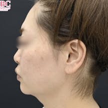 【女性・小顔】小顔用脂肪吸引注射_before