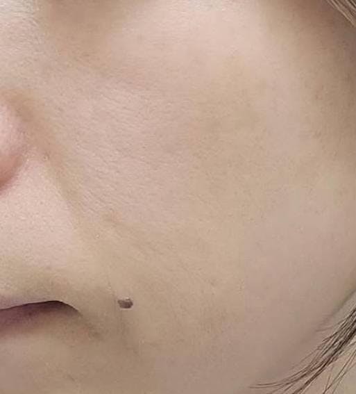 GRACY TOKYO CLINIC(グレイシー東京クリニック)でほくろ・いぼ除去を受けた791さんの写真
