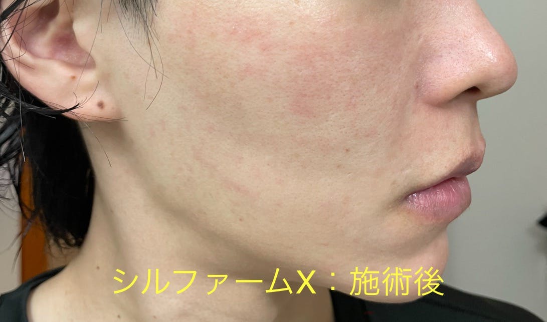 湘南美容クリニック 新宿本院でシルファームX・RF治療を受けたゆうち｜Yuchiさんの写真
