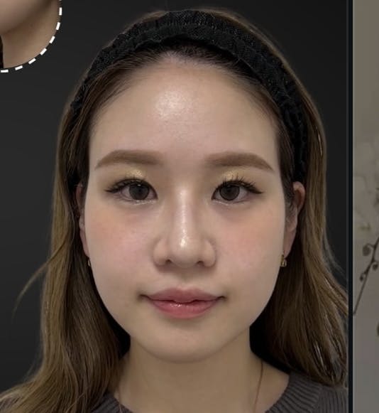 【20代女性・フェイスライン】糸リフト_a1