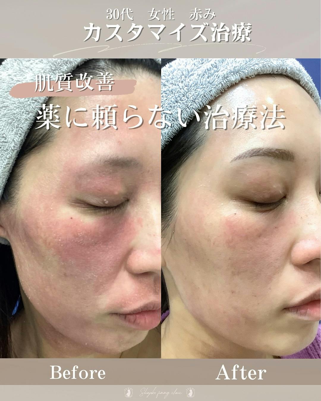 【30代女性・赤み】ACRS_before_aftar