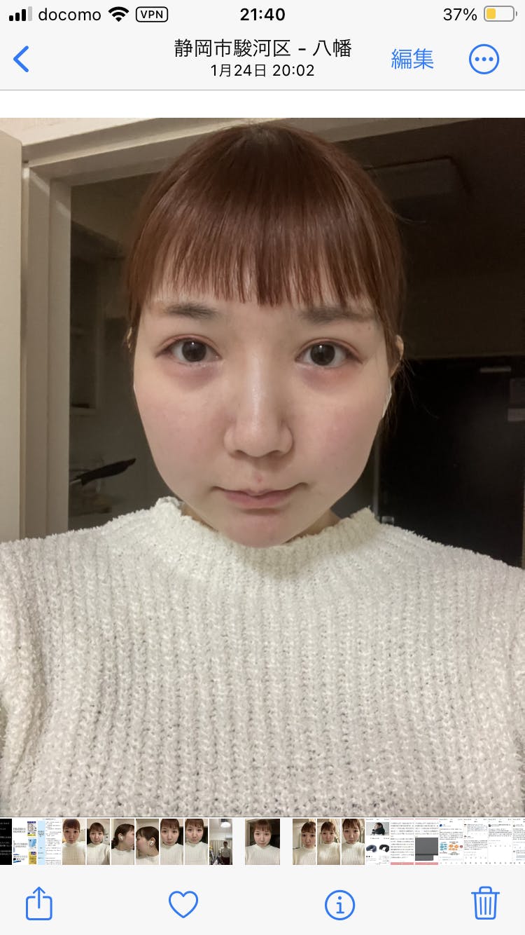 アストラビューティークリニック(ASTRA BEAUTY CLINIC)でを受けたはるさんの写真