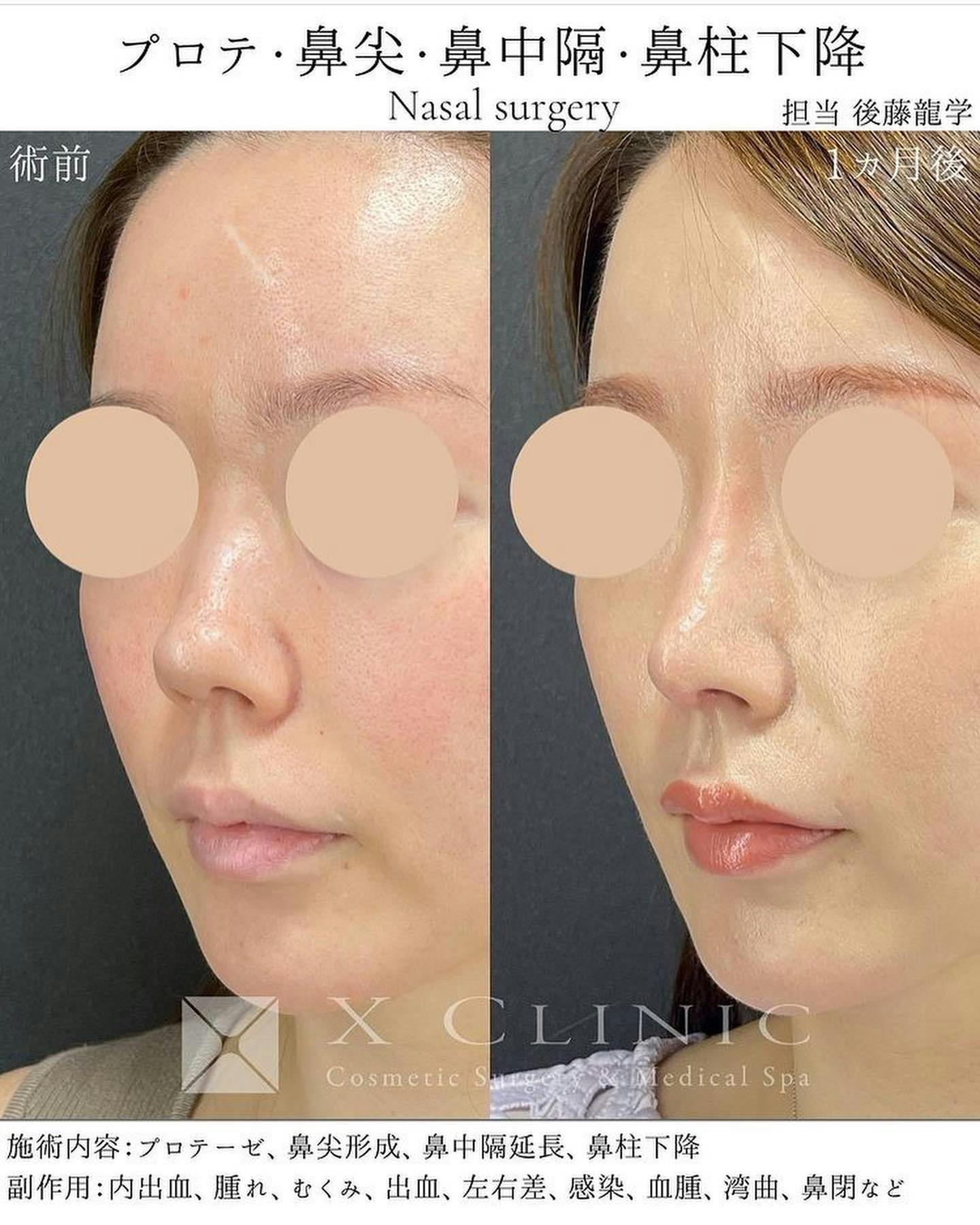 【女性・鼻】定額鼻整形（プロテーゼ、鼻尖形成、鼻中隔延長 (鼻中隔軟骨)、耳軟骨移植、鼻柱下降）_before_aftar