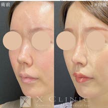 【女性・鼻】定額鼻整形(プロテーゼ、鼻尖形成、鼻中隔延長 (鼻中隔軟骨)、耳軟骨移植、鼻柱下降)_before_aftar