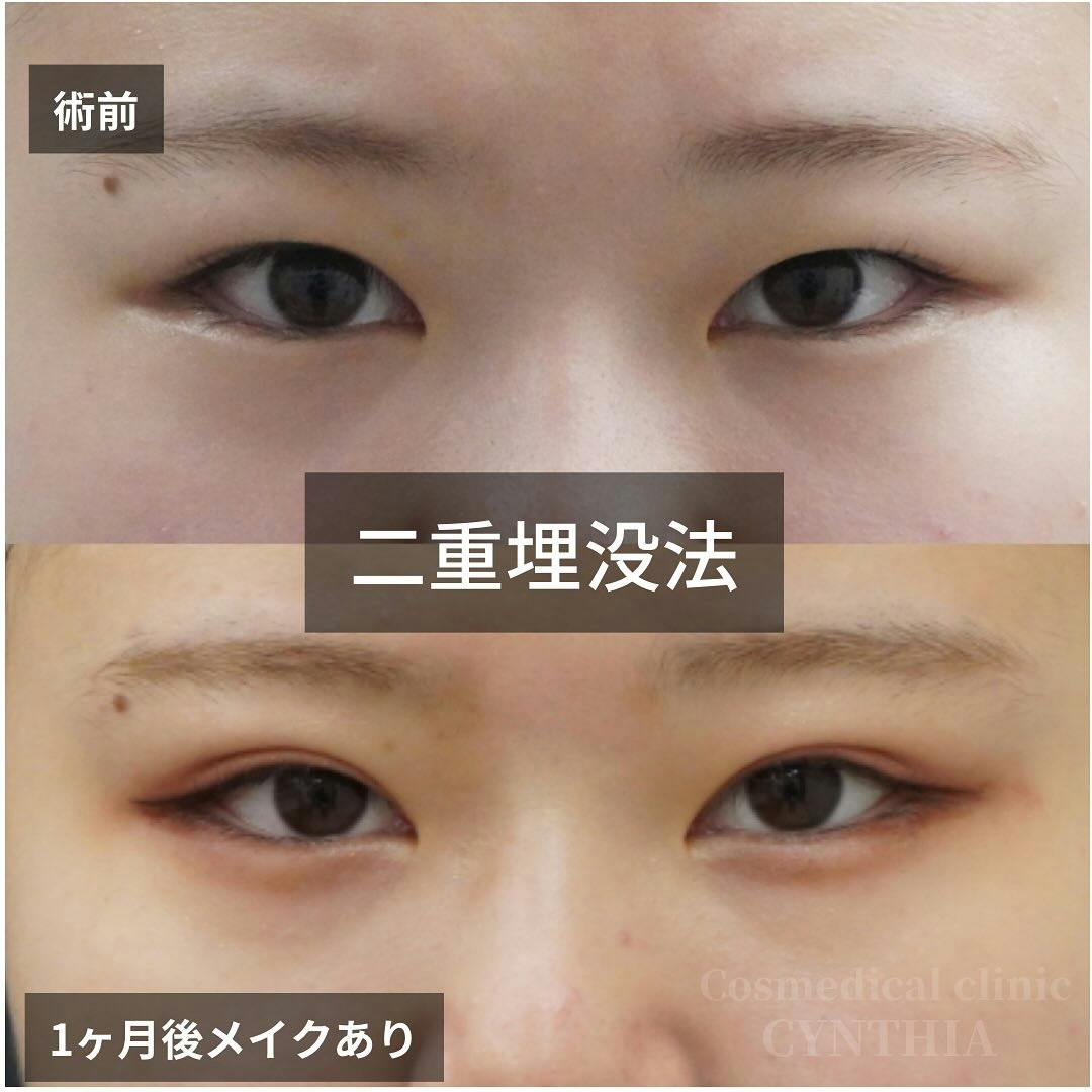 【20代女性・目元】二重埋没法_before_aftar