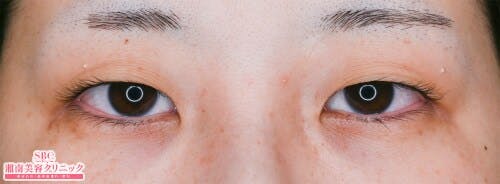 【女性・目元】クイックコスメティーク・シングルNeo、クイックコスメティーク・ダブルNeo_before