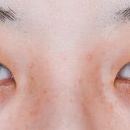 【女性・目元】クイックコスメティーク・シングルNeo、クイックコスメティーク・ダブルNeo_before