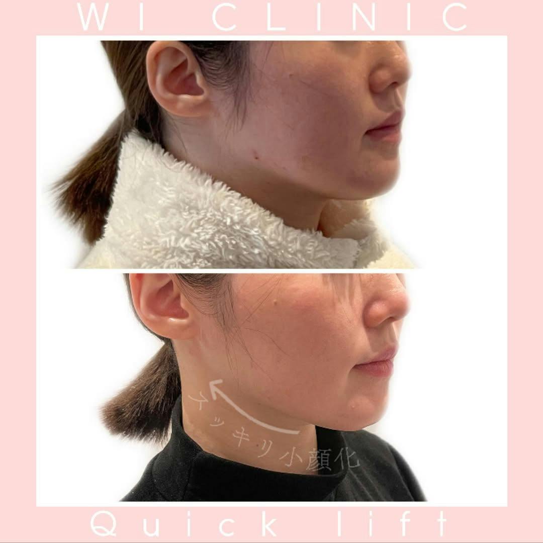 【女性・小顔】糸リフト エラボトックス_before_aftar