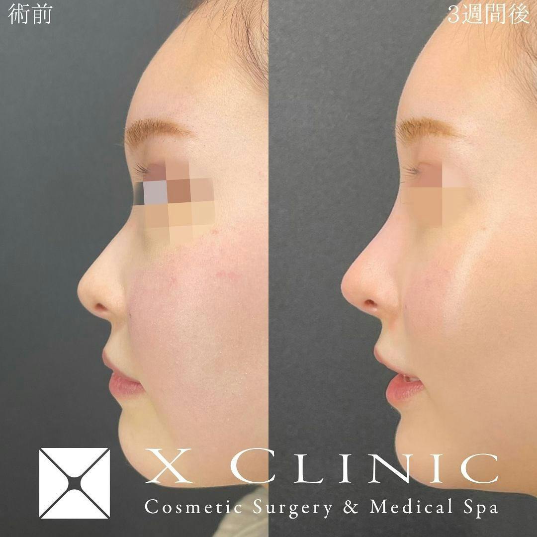 【女性・鼻】プロテーゼ 鷲鼻修正  鼻尖形成  耳軟骨移植 鼻柱挙上 小鼻ボトックス 他院修正_before_aftar