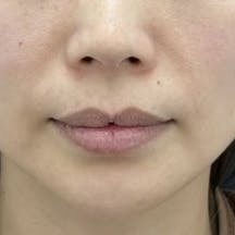 【40代女性・ほうれい線】ナチュラル脂肪注射コンデンスリッチ_before