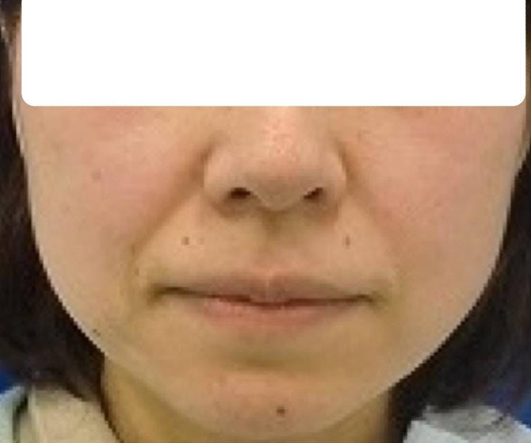 湘南美容クリニック 仙台院でhttps://crowdworks.jp/attachments/55692280.jpgを受けたなおさんの写真