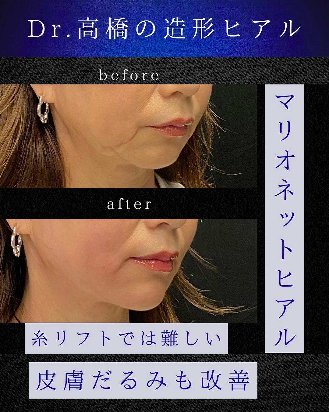 【女性・たるみ】マリオネットヒアル_before_aftar