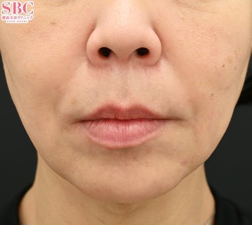 【女性・口元】切らない人中短縮、切らない口角挙上_aftar