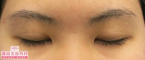 【女性・目元】クイックコスメティーク・ダブルNeo・クイックコスメティーク・シングルNeo・目頭切開プレミアム_before