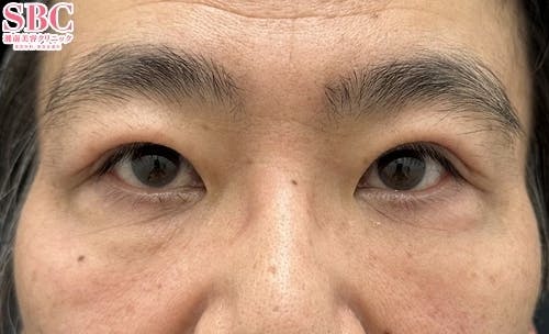 【50代男性・目元】眼瞼下垂＋二重・目の下の切らないクマ・たるみ（ふくらみ）取り_after