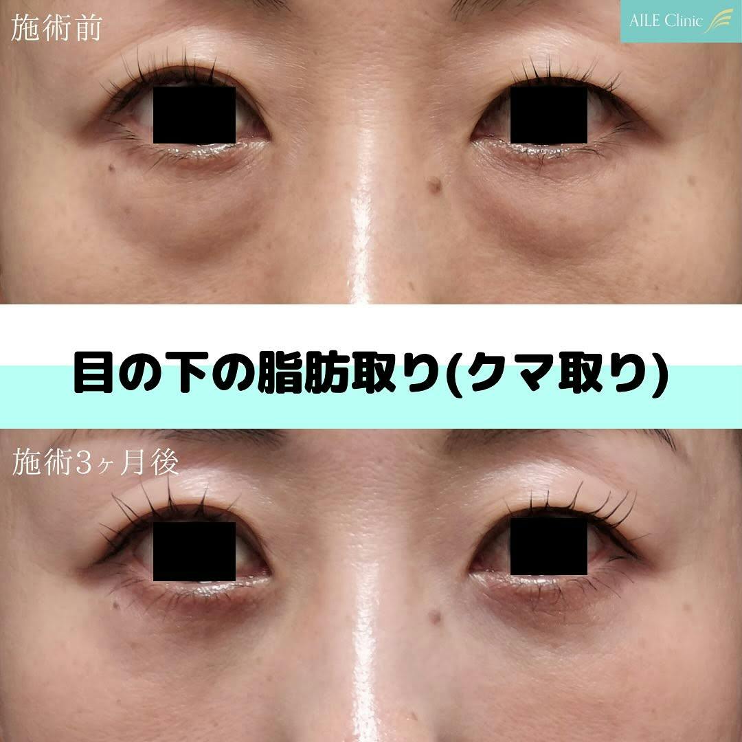 【女性・クマ】目の下の脂肪取り(クマ取り)_before_aftar