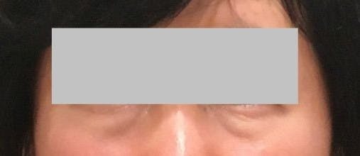 エールクリニック(AILE Clinic)で目の下のクマ・たるみ取り・目元整形・経結膜脱脂法を受けたカイさんの写真